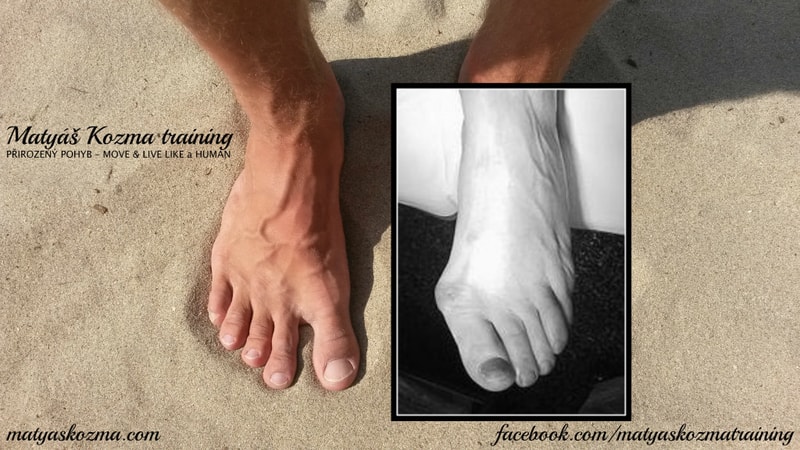 Hallux valgus, vbočený palec